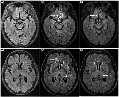 Case report: A case of anti-glycine receptor encephalomyelitis triggered by post-transplant or COVID-19 infection?